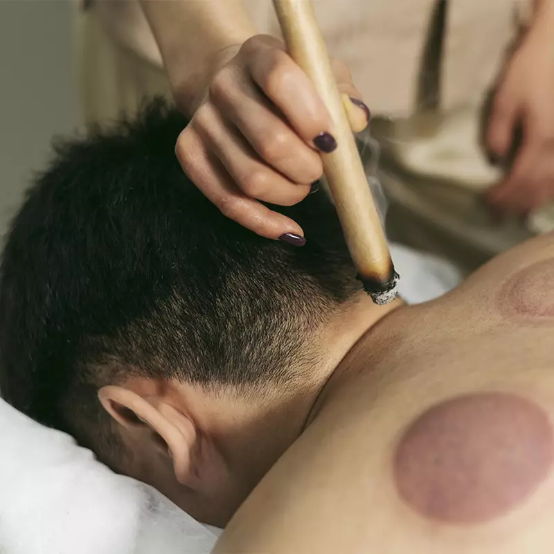 professionista che applica la tecnica della Moxibustione